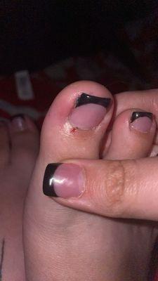 Bleeding big toe