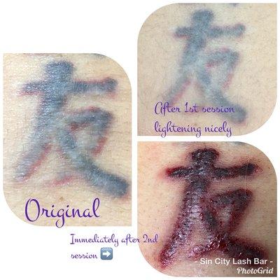 Saline tattoo removal