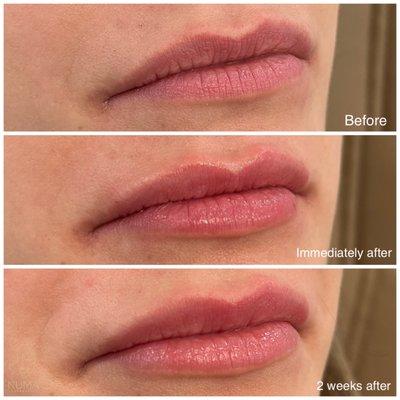 Lip filler using microcannula technique.