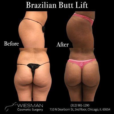 Brazilian Butt Lift (BBL) by Dr.Irvin Wiesman. Please call (312) 981-1290 to schedule your consultation!