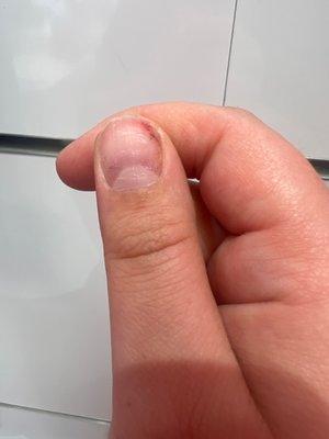 Result of improper acrylic nail removal