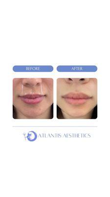 This siren got herself amazing Lip Flip results using Botox!