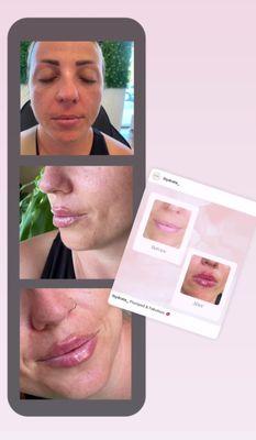 Beautiful "Russian Lip" style lips  Lip filler can help hydrate and enhance the look of your lips #Russianlip #lipfiller #chicagolips