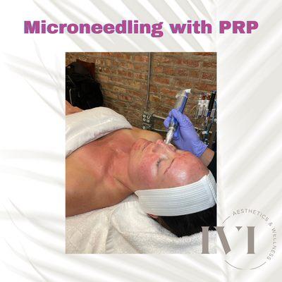 Microneedling with PRP