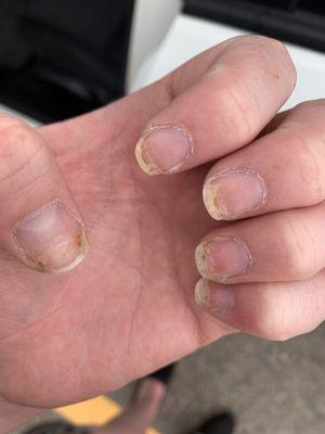 Nail fungus