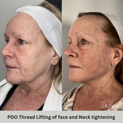 Non Surgical face lift with PDO threads. in office procedure.