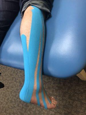 Kinematic taping to reduce calf/ Achilles' tendon pain and to improve ankle swelling.