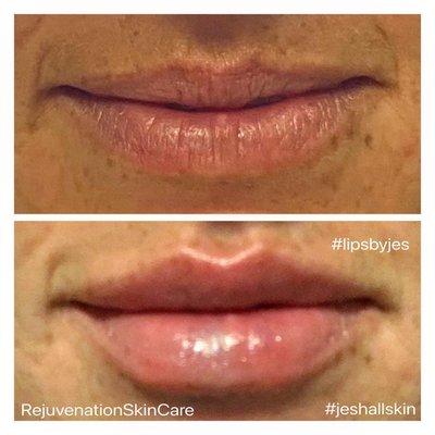 Some subtle enhancements to this beauty's lips ! 1/2 a syringe of Juvederm Ultra XC