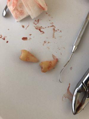 My top wisdom teeth