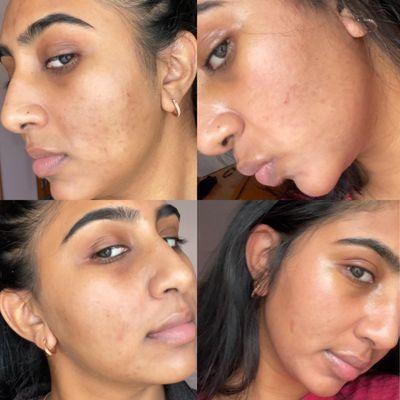 Chemical peel