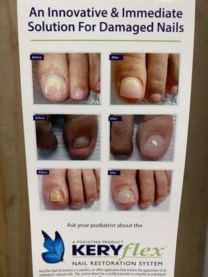 Keryflex nail applications available