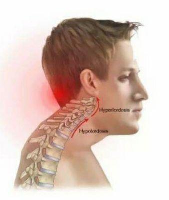 Forward head posture causes pain in the back of the neck.