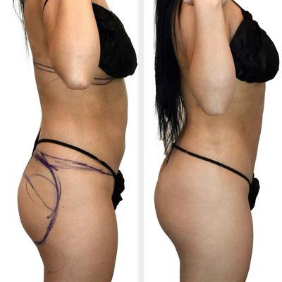 Before and After: Fat Transfer - Natural Brazilian Butt Lift