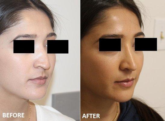 Before and After Rhinoplasty with Ear Cartilage Grafts, Septoplasty, Turbinate performed by Dr. Albert Chow