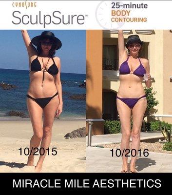 25-Minute BODY contouring