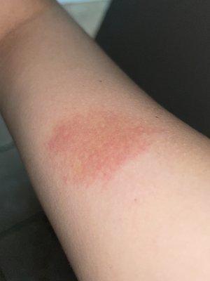 A few days later the bed bug bite progress