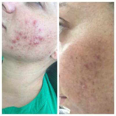 Before & After 1 month results