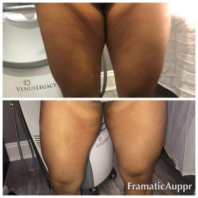 Venus freeze skin tightening on inner thighs  before and after photo.