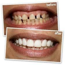 Veneers!!