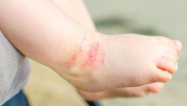 Portland Pediatric Eczema Treatment