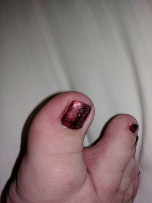 Yes, that's blood and a missing chunk to the left side of my toenail