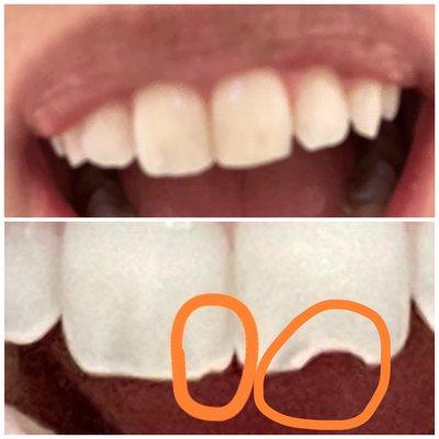 Bottom: teeth prior to visit  Top: filling done by Dr Vaszquez