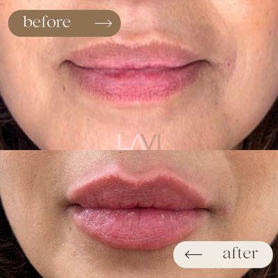 Subtle transformation with just 1/2 syringe of lip filler.