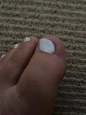 Ingrown toenail caused by male pedicurist.