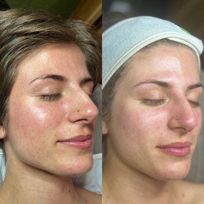 Before & after calming CBD facial for rosacea client