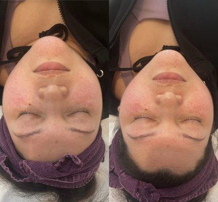 Micro current, tighten the muscles of the face for a slimming effect!