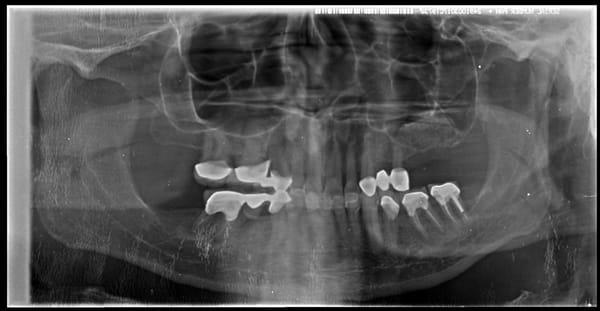 Lateral Window Sinus Augmentation (Sinus Lift) of the same patient. He will be ready for implant placement in 4 months.