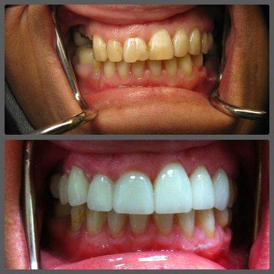 A beautiful case of crowns and veneers.