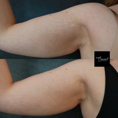 before and after of stretch mark camouflaging