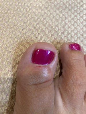 Cut on cuticle and minor infection the day after I had toes done at Envy Nails