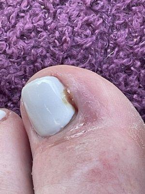 Infected toenail