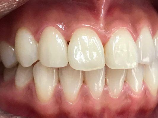 Single crown matched to the adjacent teeth. You may wonder which one?