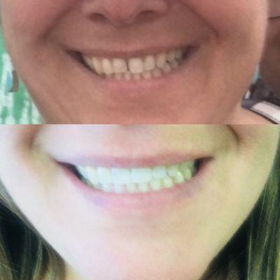 The first photo was a month  ago the second one is today after getting my teeth fix !