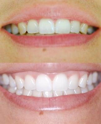 Whitening