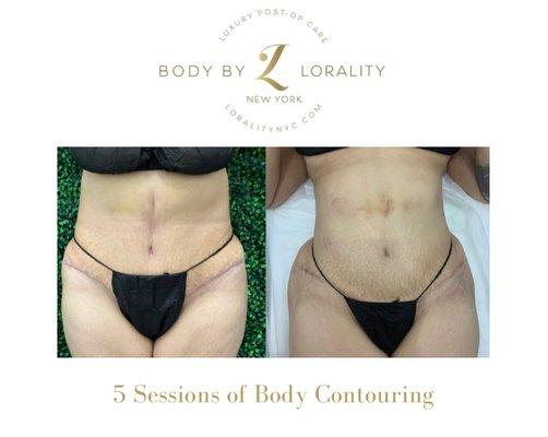 5 Sessions of Body Contouring