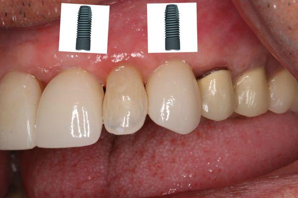 Implants can help with replacement of missing teeth as in this smile with no evidence of their presence.