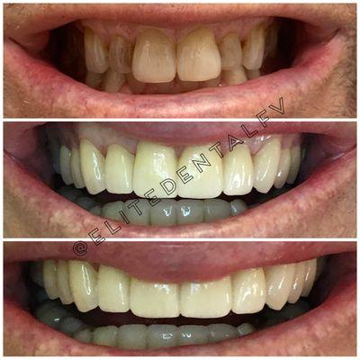 10 Veneers/Porcelain Crowns on the upper arch + Zoom Teeth Whitening 
Done by Dr. Azi.