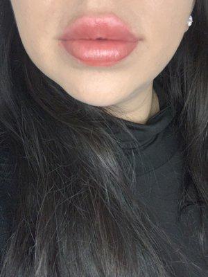 1weeks after juviderm second syringe. Im wearing chapstick and this is my lips with natural light and no filter.