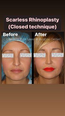 Closed Rhinoplasty technique