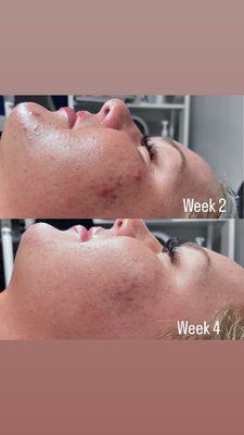 8 week treatment series consisting of one weekly facial and a full home care routine to manage acne pustules and scaring.