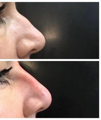 Non surgical nose augmentation