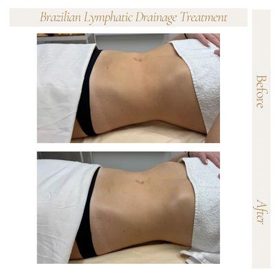 Lymphatic Drainage