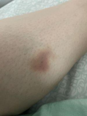 Next day, several bruises