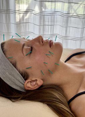 Facial Acupuncture