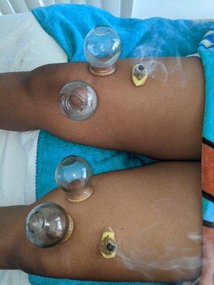 Knee pain relief, moxibustion and fire cupping