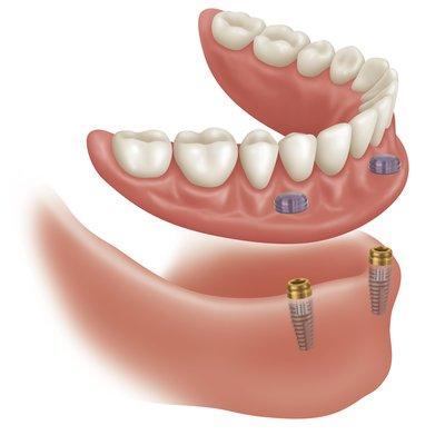 "Snap on" type overdenture